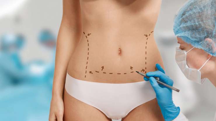Liposuction