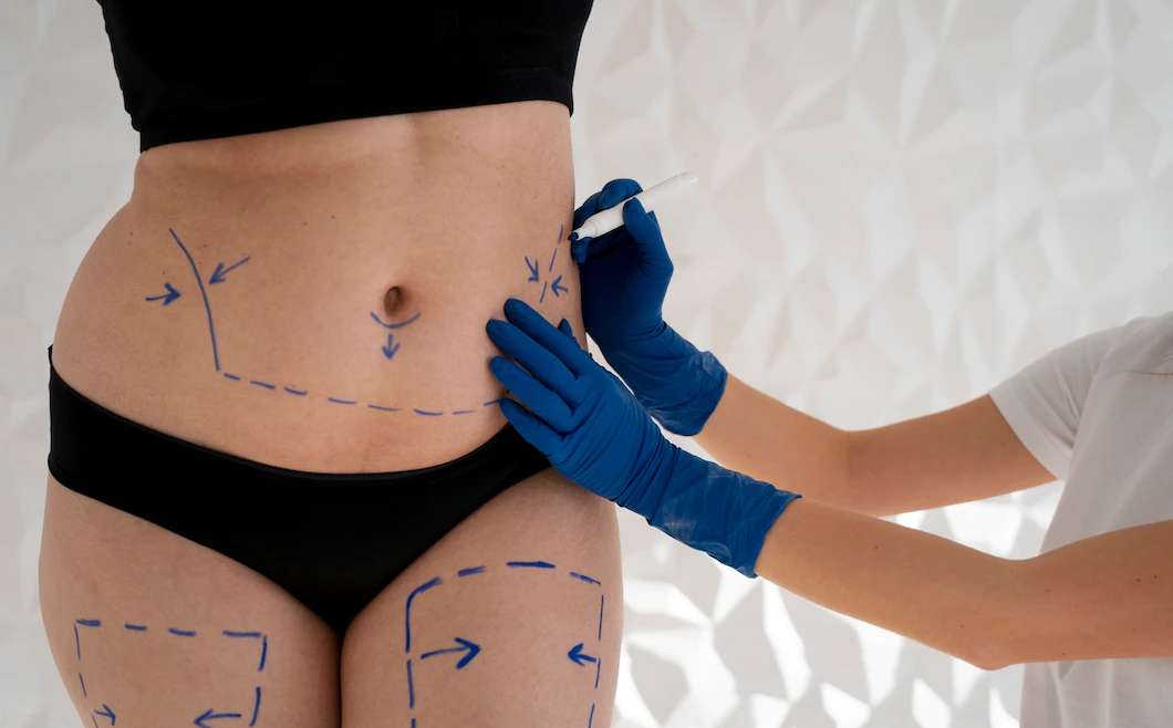 TUMMY TUCK / ABDOMINOPLASTY SURGERY
