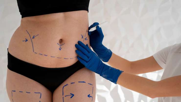 TUMMY TUCK / ABDOMINOPLASTY SURGERY